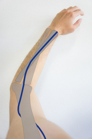橈骨神経のアームローテーションラインの画像